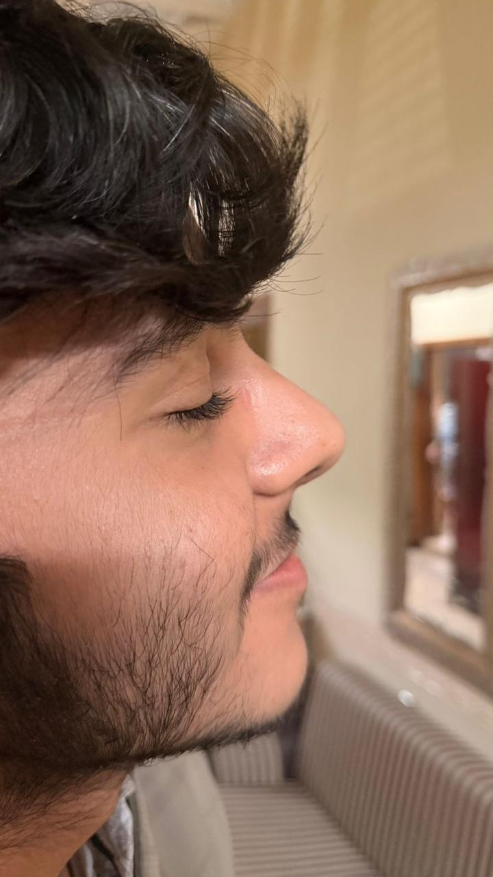 After Septorhinoplasty