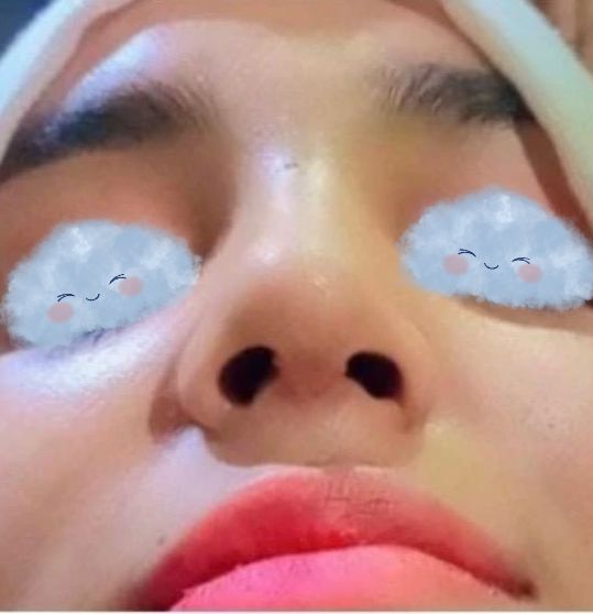 After Aesthetic Rhinoplasty