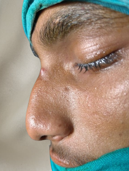 Before Septorhinoplasty