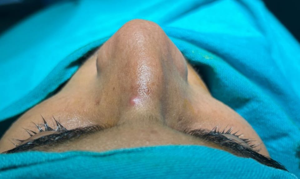 Before Aesthetic Rhinoplasty